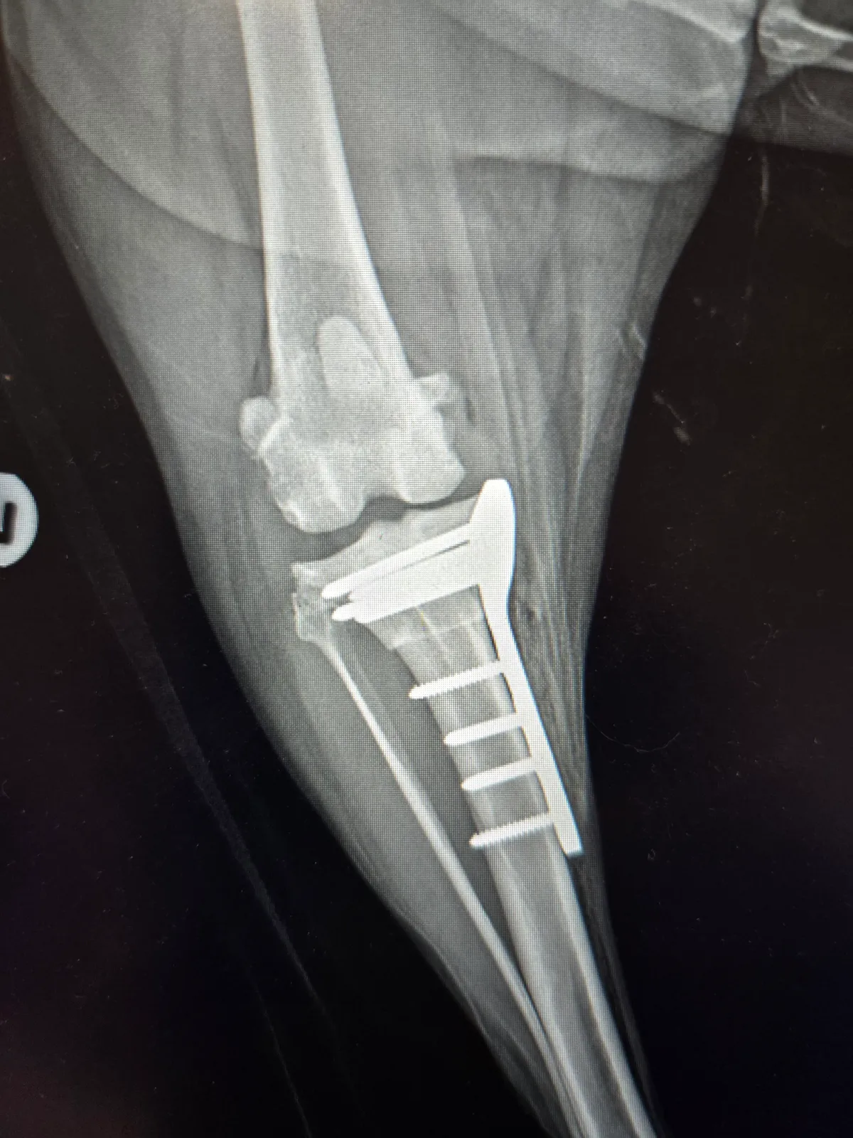 A post-operative X-ray showing an orthopaedic fracture repair — a bone plate secured with screws
